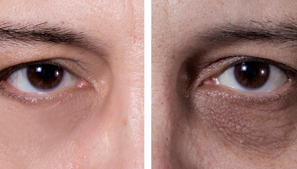 What Causes Dark Circles & How to Brighten Your Eyes