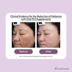 Clinical evidence for the reduction of melasma with Oral PLE supplements