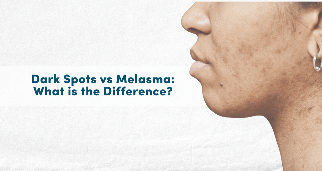 Dark Spots vs Melasma: How to Tell the Difference