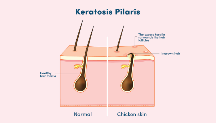 Keratosis Pilaris: What is it and treatment