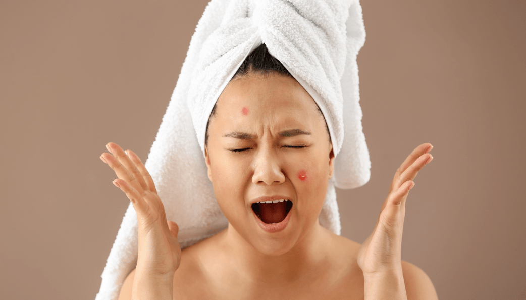 What Causes Adult Acne?