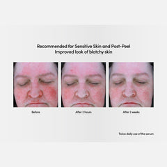 Before & After photo of Exuviance Professional Soothing Recovery System
